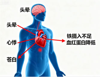 复方硫酸亚铁片真的比普通铁剂更有效吗？深入解析其独特优势与正确用法